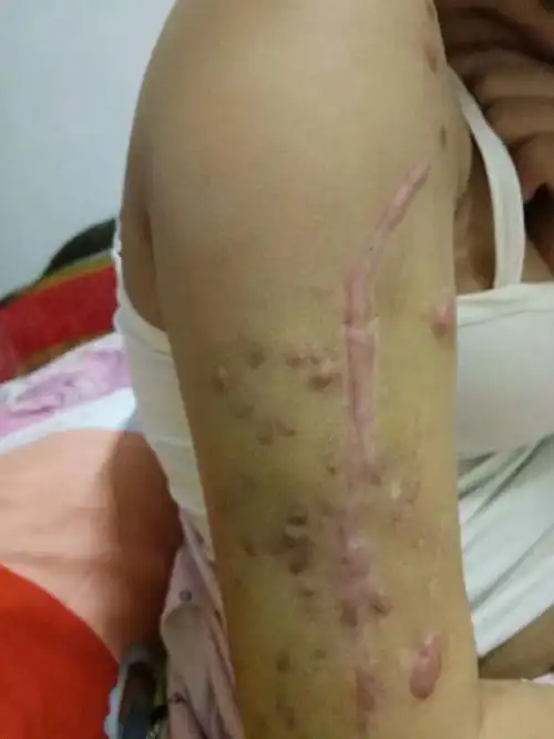 经过三次手术,仍旧有数十颗子弹尚未取出,而且其中部分子弹位于颈椎