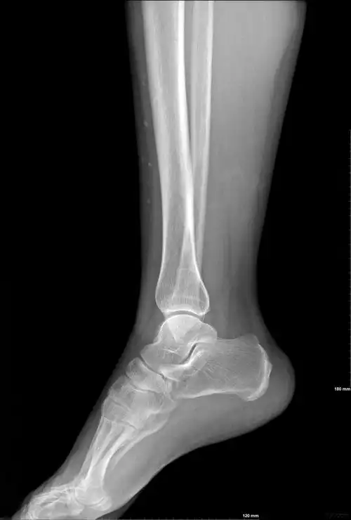 请大家帮忙看看胫骨前方高密度影是什么