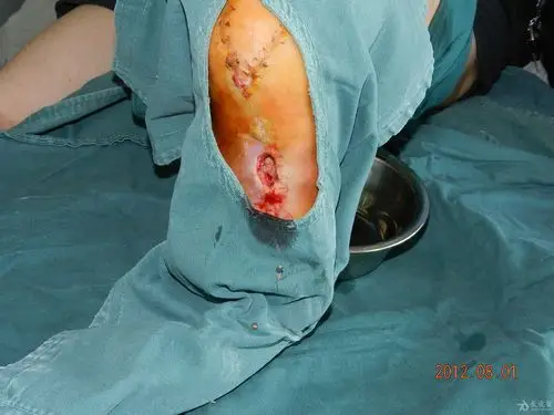 千方百计治愈一例跟骨慢性骨髓炎21年根部溃疡15年经久未愈的病例