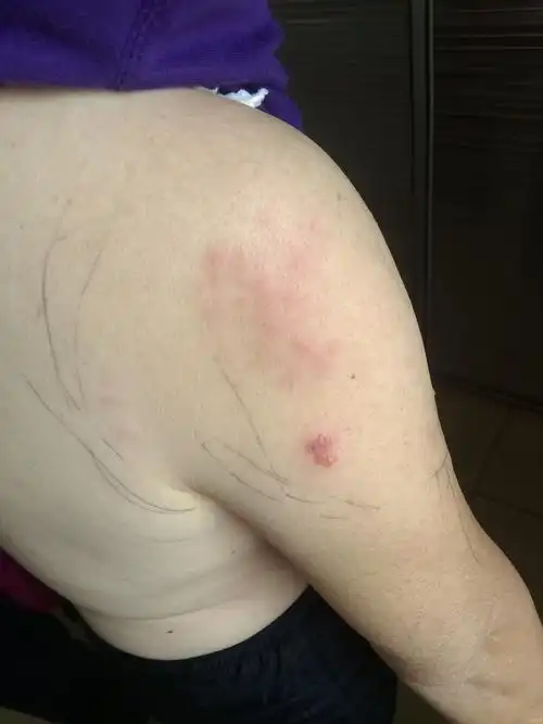 带状疱疹么? - 皮肤及性传播疾病讨论版 - 爱爱医医学论坛