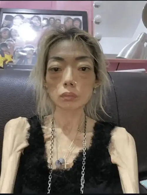 "内卷"下暴瘦的9位女星,有人瘦到22公斤,体力不支只能坐轮椅