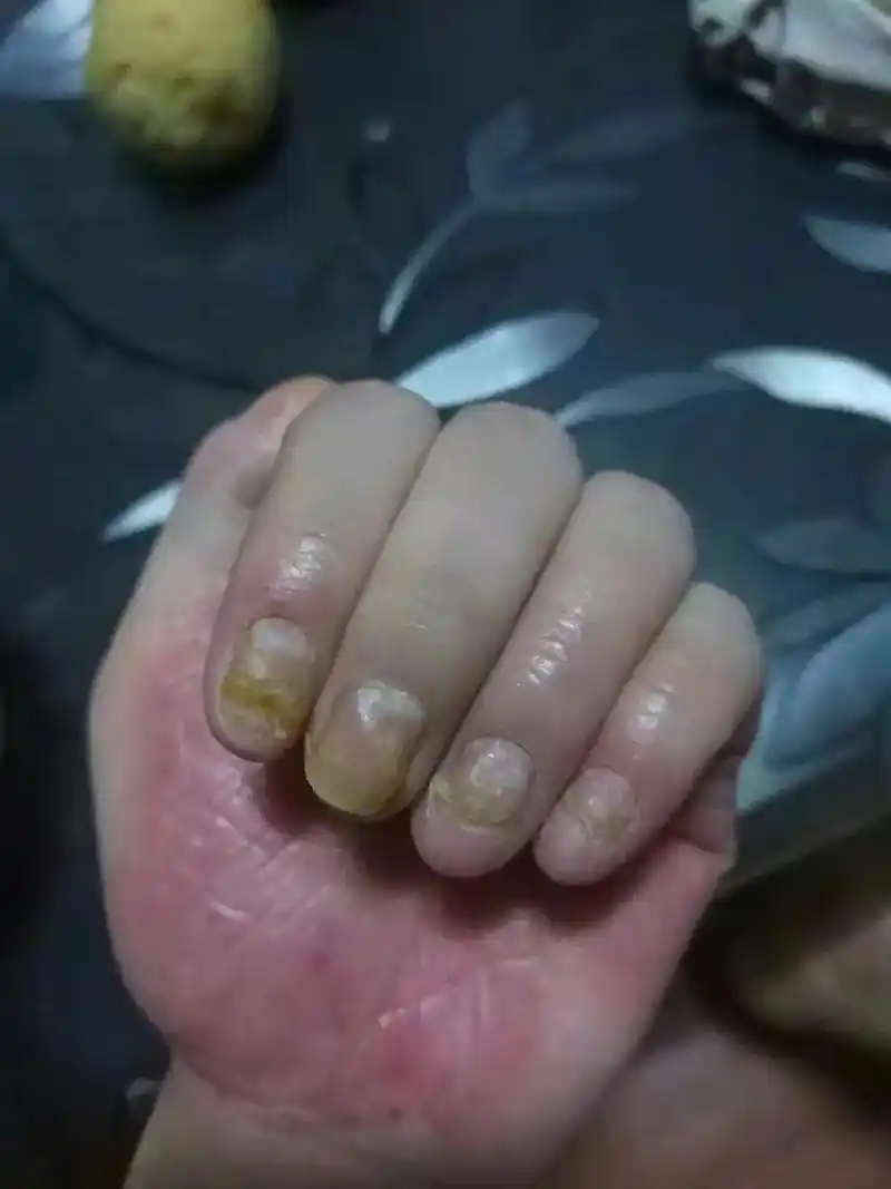 掌跖脓包和肢端皮炎 - 抖音