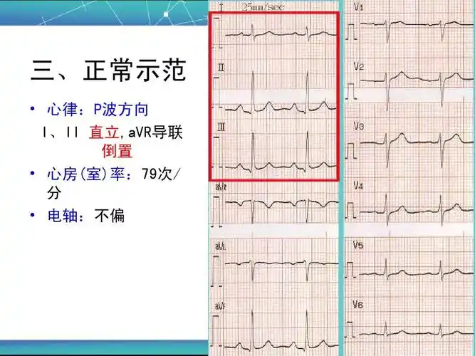 正常心电图1ppt