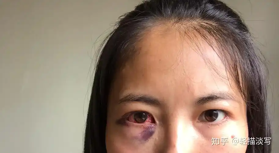 记录斜视手术的一天n - 知乎