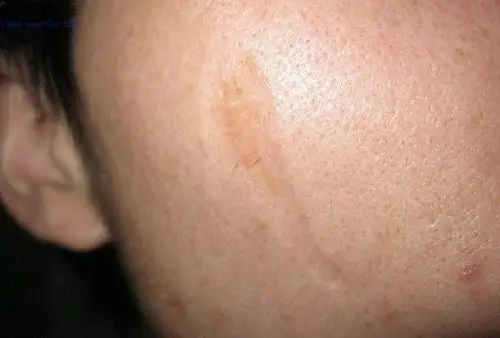 胥肖琴医生讲解凹陷疤痕慢慢能长平吗