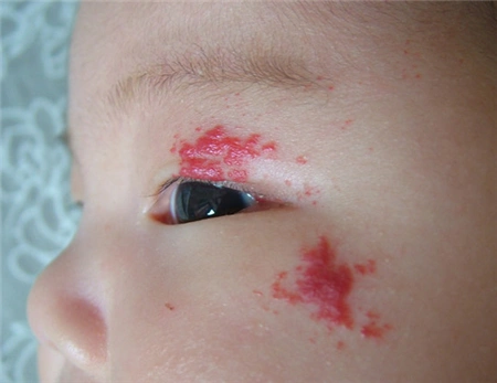 新生儿鲜红斑痣的原因