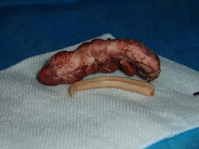 在手术室里,那些被切下来的包皮,肿瘤都到哪里去了?请看此文__凤凰网