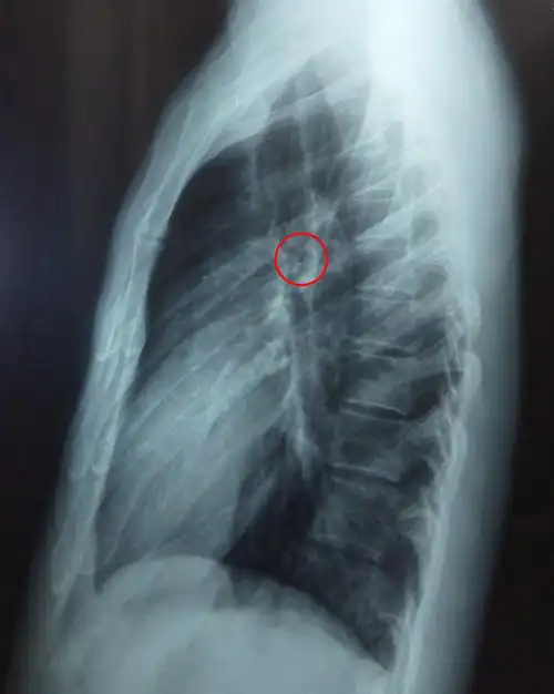 1 2010-09-24 癌症的肺部阴影多为高密度阴影 今天去做透视医生说我