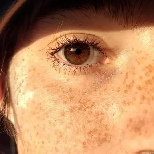 这种色素沉着不仅影响皮肤的美观,还会给女性带来心理压力.