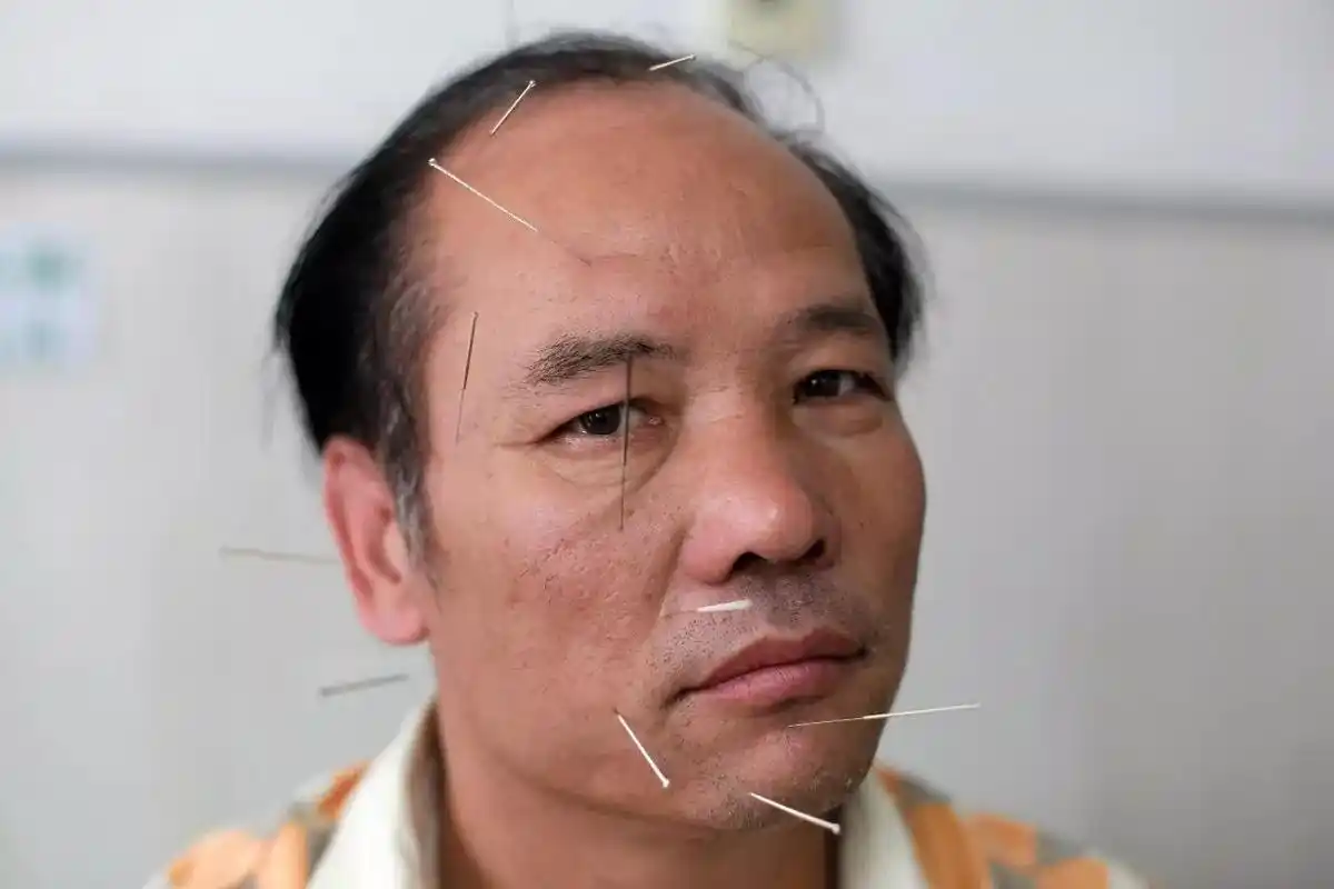 2010年6月5日,北京一家中医医院的病人接受针灸治疗,治愈面部右侧面瘫