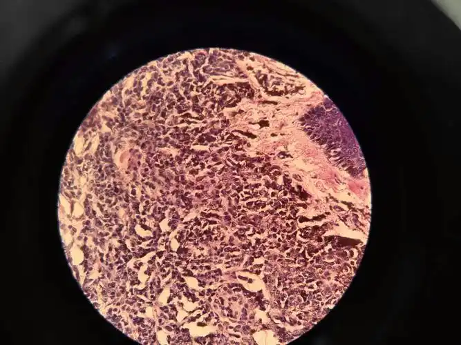 色素痣 - 华夏病理网论坛