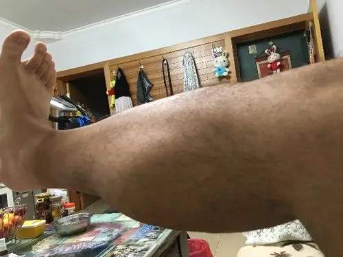 男性,之前240斤,经过四个月慢跑瘦到190,但发现小腿腓肠肌部位肥大