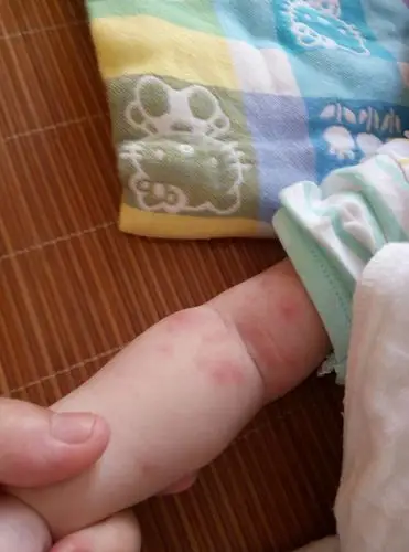 不知道是热毒还是之前打过丙球药水的问题.