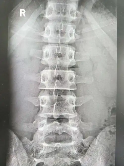 腰椎间盘突出症的阶梯性治疗