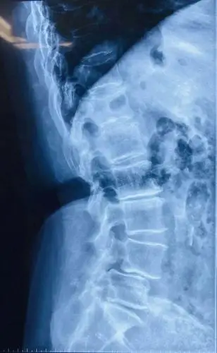 ube技术下3d打印钛合金融合器植入内固定治疗腰椎滑脱并椎管狭窄症
