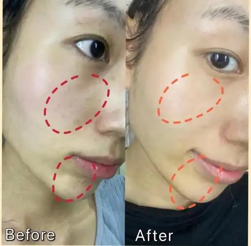 dpl光子嫩肤效果怎么样?