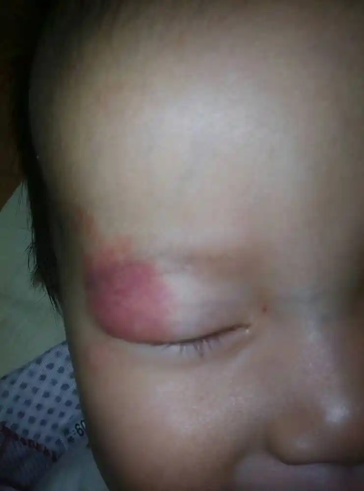 红色胎记宝宝眼皮上边出生就有一块红色的胎记,不突出皮肤,情绪激动会