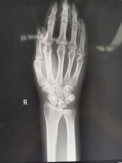 腕舟骨骨折经皮微创治疗 - 好大夫在线