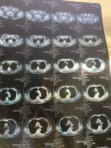 检查 检查项目:胸部x光片(胸片),ct,mri(核磁共振),pet/ct,活检