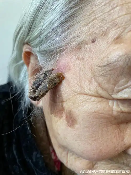 切除的肿物病理证实是:皮肤鳞状细胞癌,该病容易转移,增长迅速.