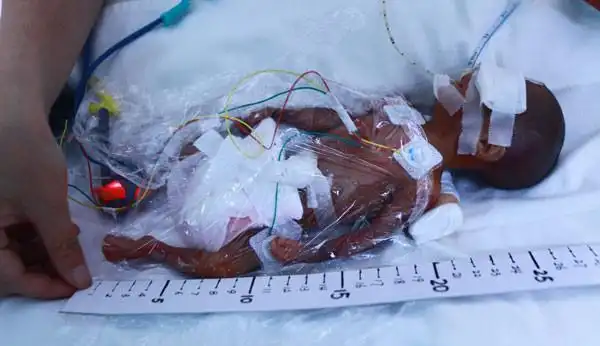 男婴出生只有1斤身体比成人巴掌大一点现在只能为孩子祈福