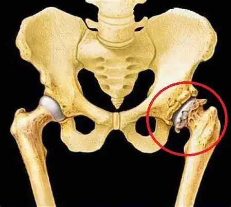 是一支纯感觉神经 , 简单理解就是这根神经支配股骨外侧皮肤的感觉