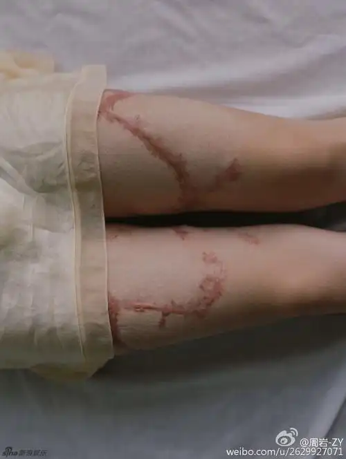 烧伤女孩周岩旧照甜美清纯性格坚强阳光18