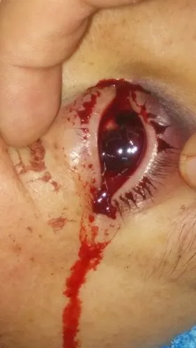 【眼外伤讨论】眼球破裂伤1例 [病例帖]