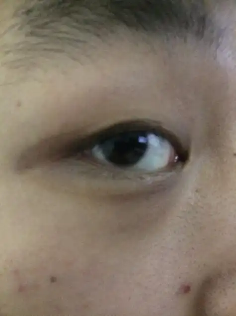眼角黑怎么办?