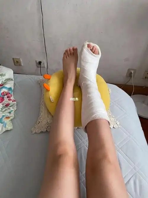 绑石膏第16天绑石膏的腿能瘦