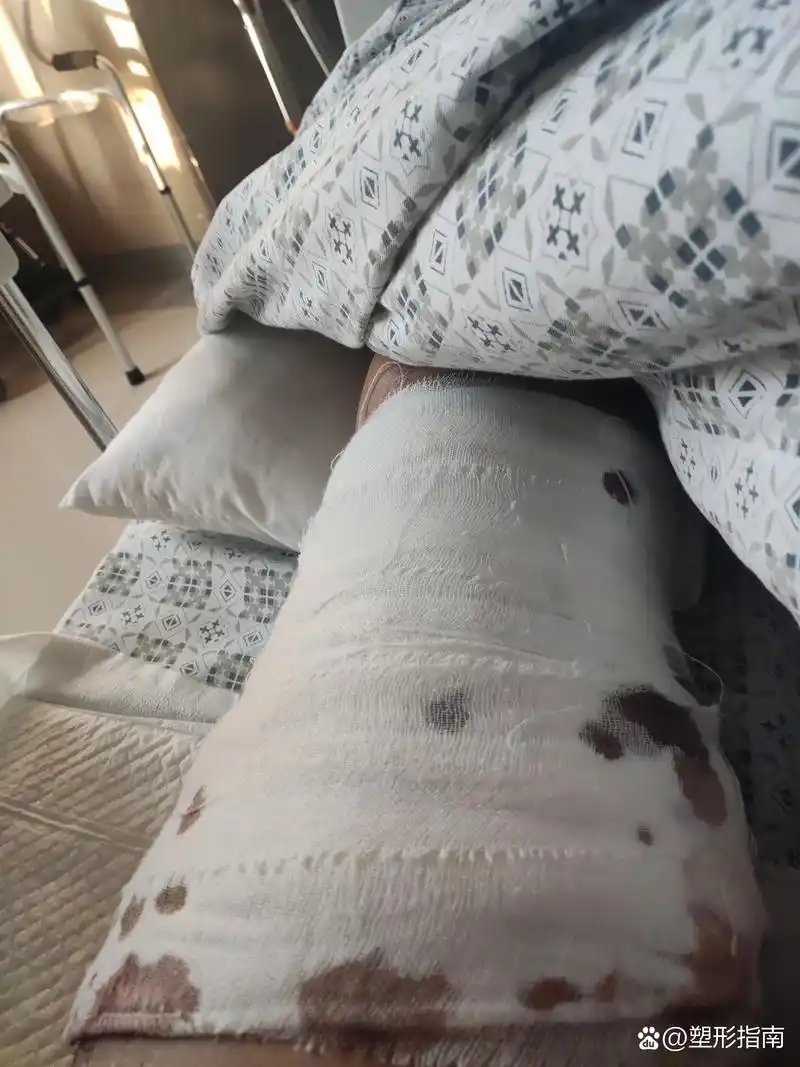 植皮术后79天,我该怎么办…… 取皮区越来越差了,好的地方都破了,现在