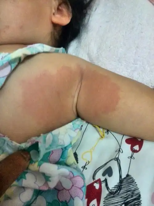 宝宝腋下大腿根部一整片很红.脸部有些小包