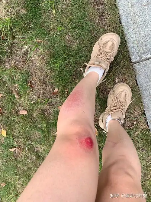 早上上班路上骑车不小心摔伤了,摔到了膝盖,小腿也有轻微擦伤.