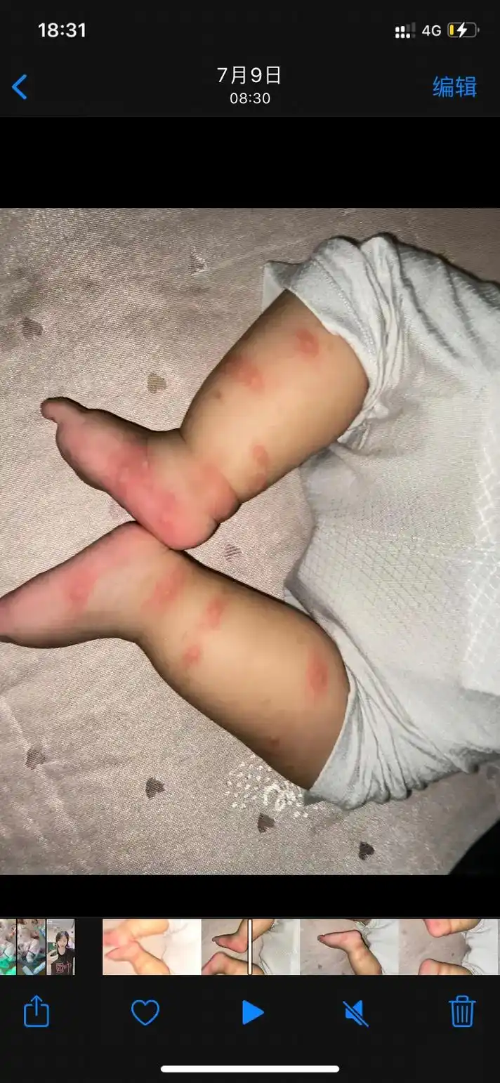 外公 #蚊虫叮咬#皮肤 除了爸爸妈妈,外公最疼你了宝,身上 - 抖音