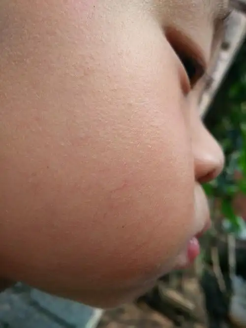 儿子脸上长了红血丝 有没有简单易操作的办法 很捉急啊 身边亲戚朋友