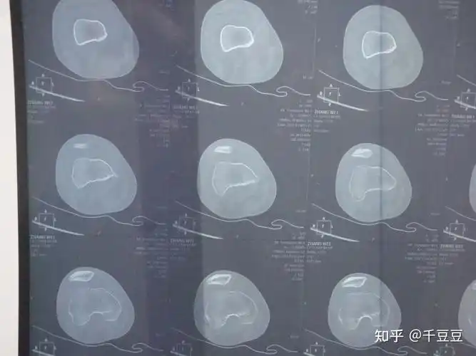 胫骨平台塌陷ct图片