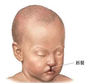 唇腭裂修复手术的基础常识