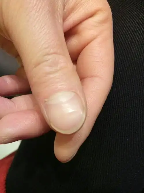 大拇指甲出现凹凸是什么意思