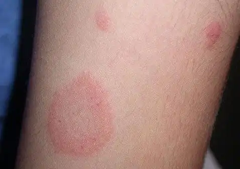 斑块型银屑病早期症状图片