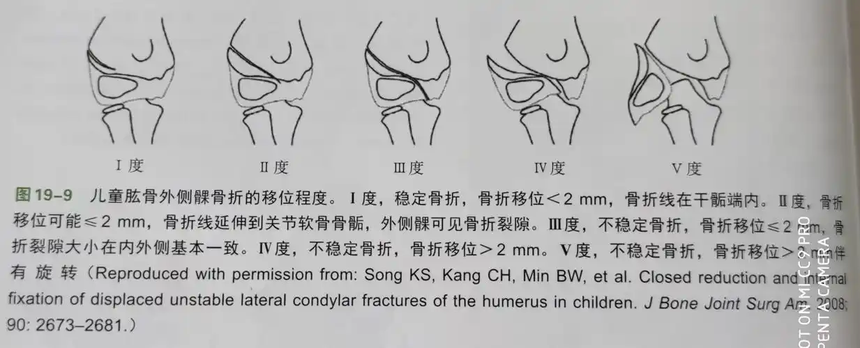 儿童肱骨外侧髁骨折song分型的临床意义
