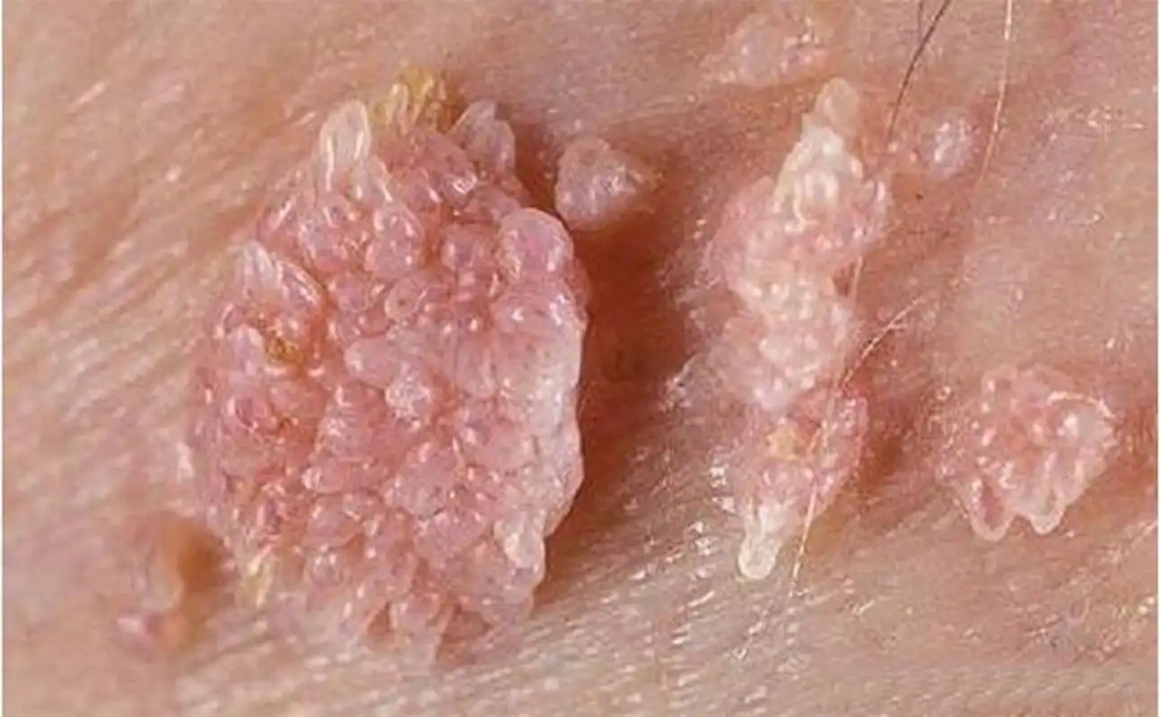 单孔荣主任# 分享正确治疗#尖锐湿疣# 的方法 男童喉咙长菜花样肿块