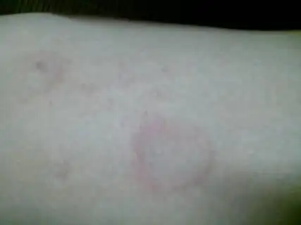 你好 医生 我身上长了一种癣,是一圈一圈的,一个圆的,中间是好的,这种