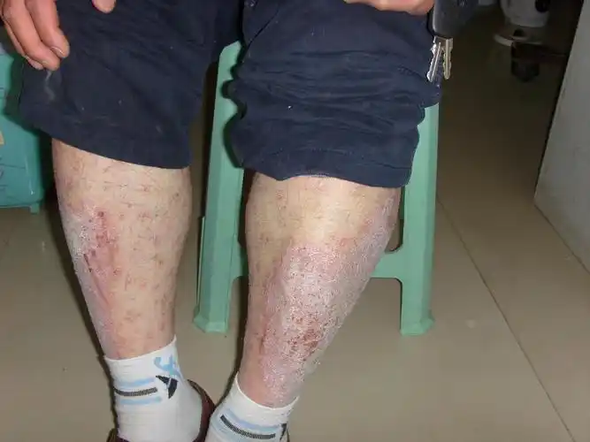 看图诊断治疗春季皮肤病病例征集