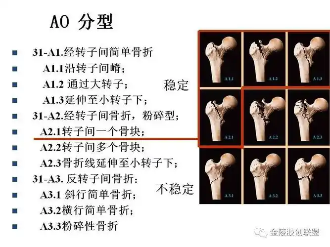 股骨转子间骨折的分型及内固定选择