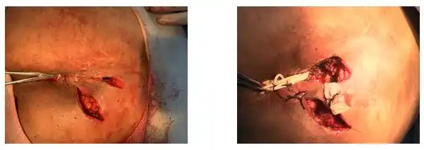 手术笔记高位复杂性肛瘘挂线术