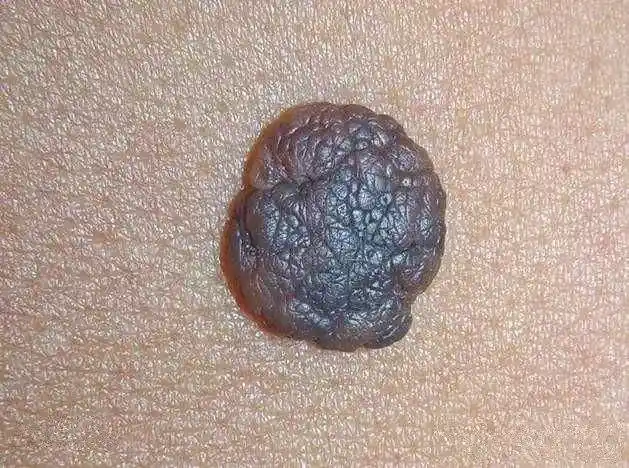 身上长痣很正常,但身上长出这两种痣,就应该提高警惕了!别忽视