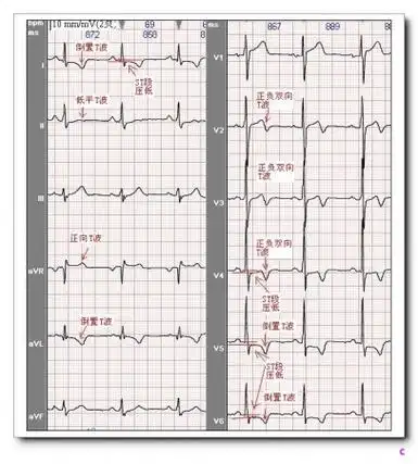 山羊老师课程常见心电图基础知识讲座第十一讲t波分析