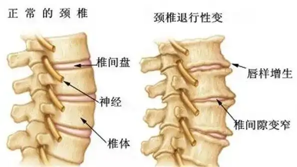 什么是颈椎管狭窄及颈椎管狭窄的症状