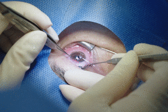 近视手术全过程实录想摘镜的你一定要看