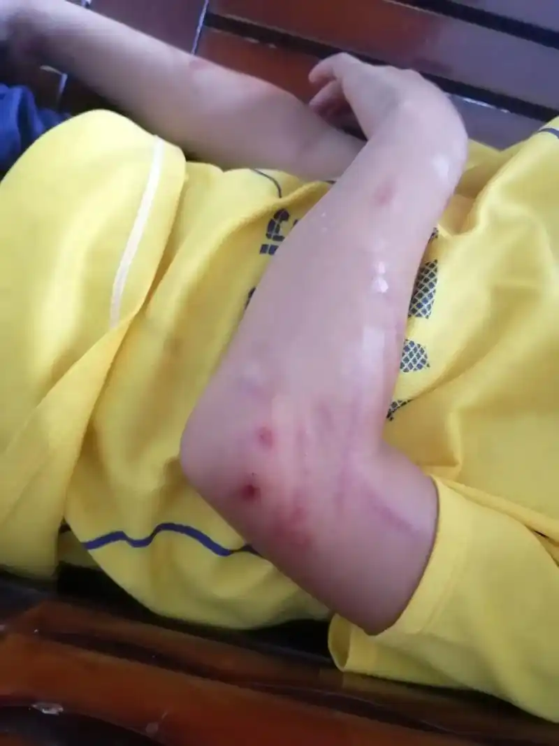 忍着眼泪趁你睡着了偷偷帮你擦药,但还是惊醒你睁开眼看了我一眼 - 抖